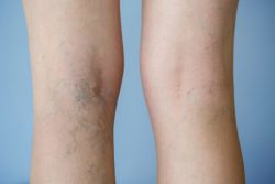 Know the Causes and Types of Vein Disease
