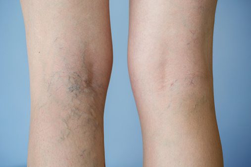 Sclerotherapy in Springboro, OH