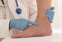 The Cause & Treatment of Spider Veins