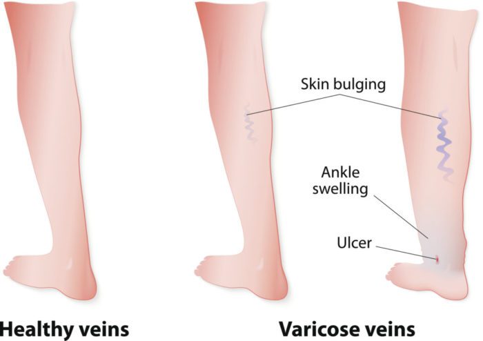 progression of varicose veins