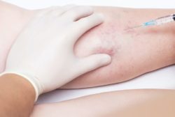 sclerotherapy in Cincinnati Ohio; treatment for your varicose and spider veins