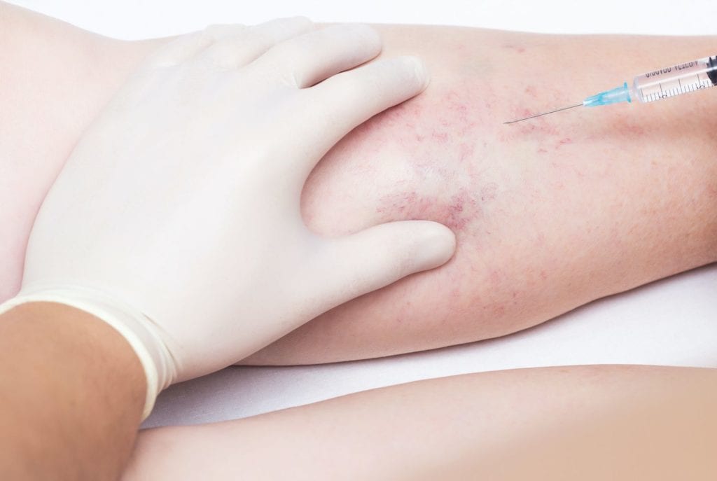 How Successful is Sclerotherapy in Cincinnati OH?