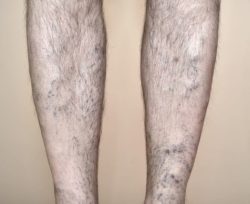 Can Men Suffer From Varicose Veins? vein treatment center in Dayton, Ohio