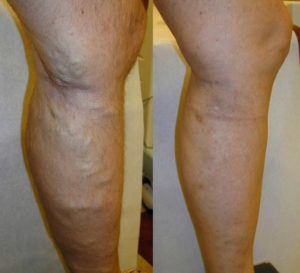 Before and after vein treatments