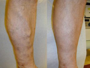 Before and after vein treatments