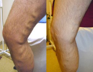 Before and after vein treatments