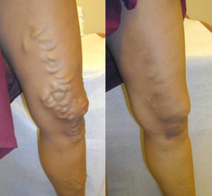 Before and after vein treatments