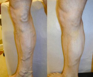 Before and after vein treatments