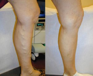 Before and after vein treatments