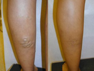 Before and after vein treatments