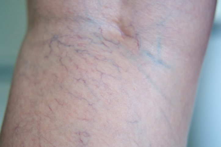 Do Visible Veins Always Mean Damage