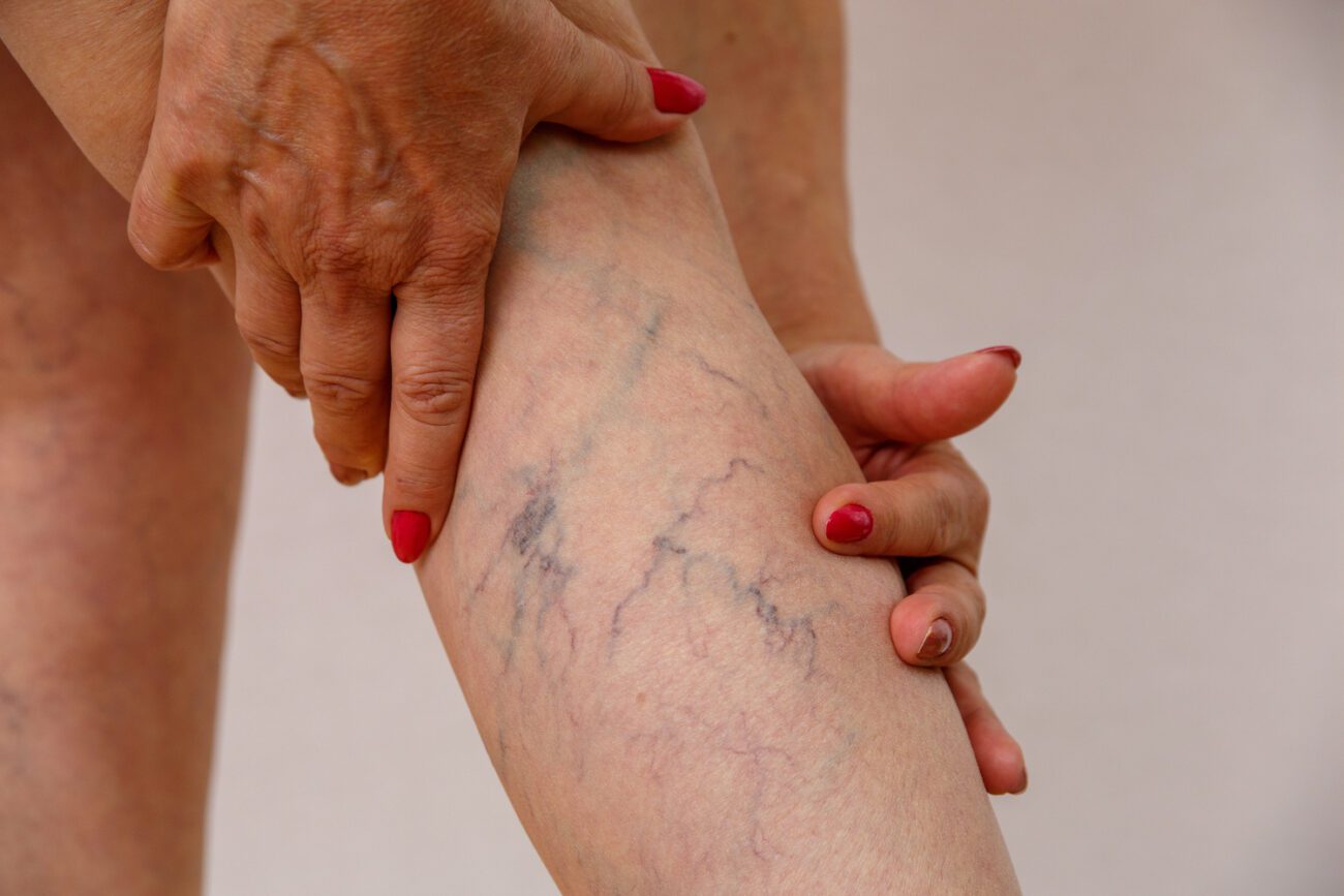 Seeking spider vein treatment can have multiple benefits that extend beyond mere aesthetics, such as improved blood flow.