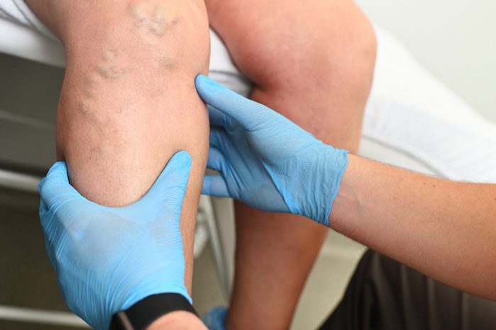 about vein disease in springboro, ohio