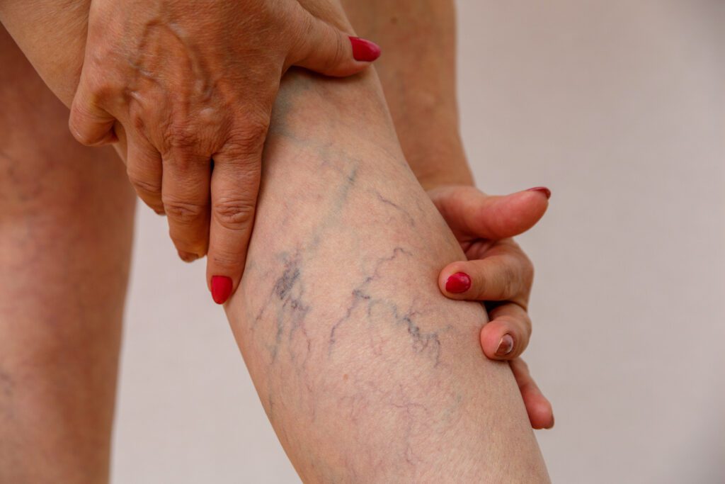 Endovenous Laser Treatment offers a modern and effective alternative to traditional vein stripping surgery, helping patients find relief.