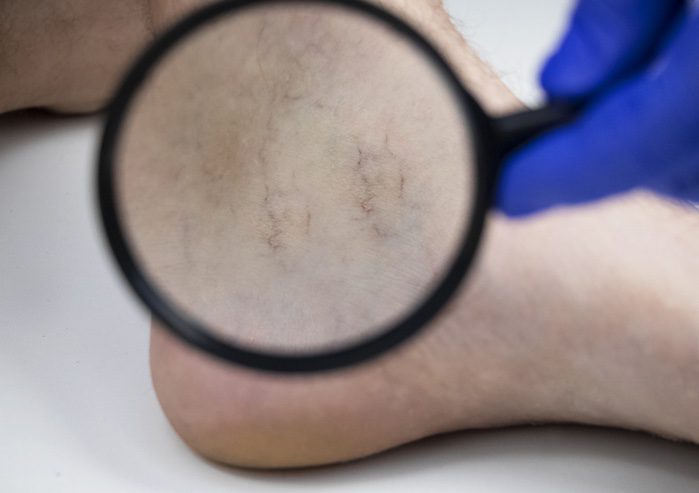spider vein treatment in springboro, ohio