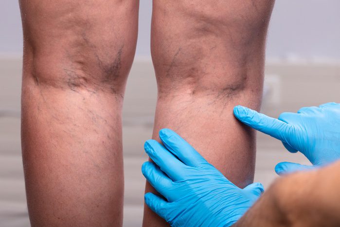 treating leg vein conditions in springboro, ohio
