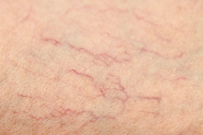 treating spider veins in springboro, ohio
