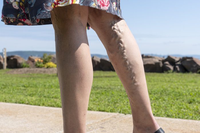 treating varicose veins in springboro, ohio