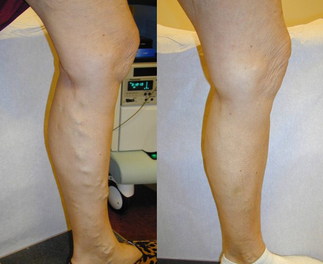 Choosing to treat varicose veins is not just about improving how your legs look. It's about protecting health and enhancing quality of life.